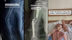 Kisah Hani Hanafiah, Wanita Asal Bandung Terkena Osteosarkoma